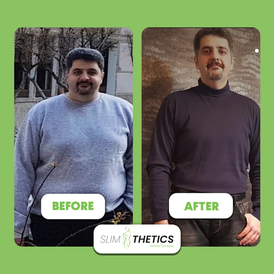 Tariq N. — Sleeve Gastrectomy patient at JJ Aesthetics Islamabad