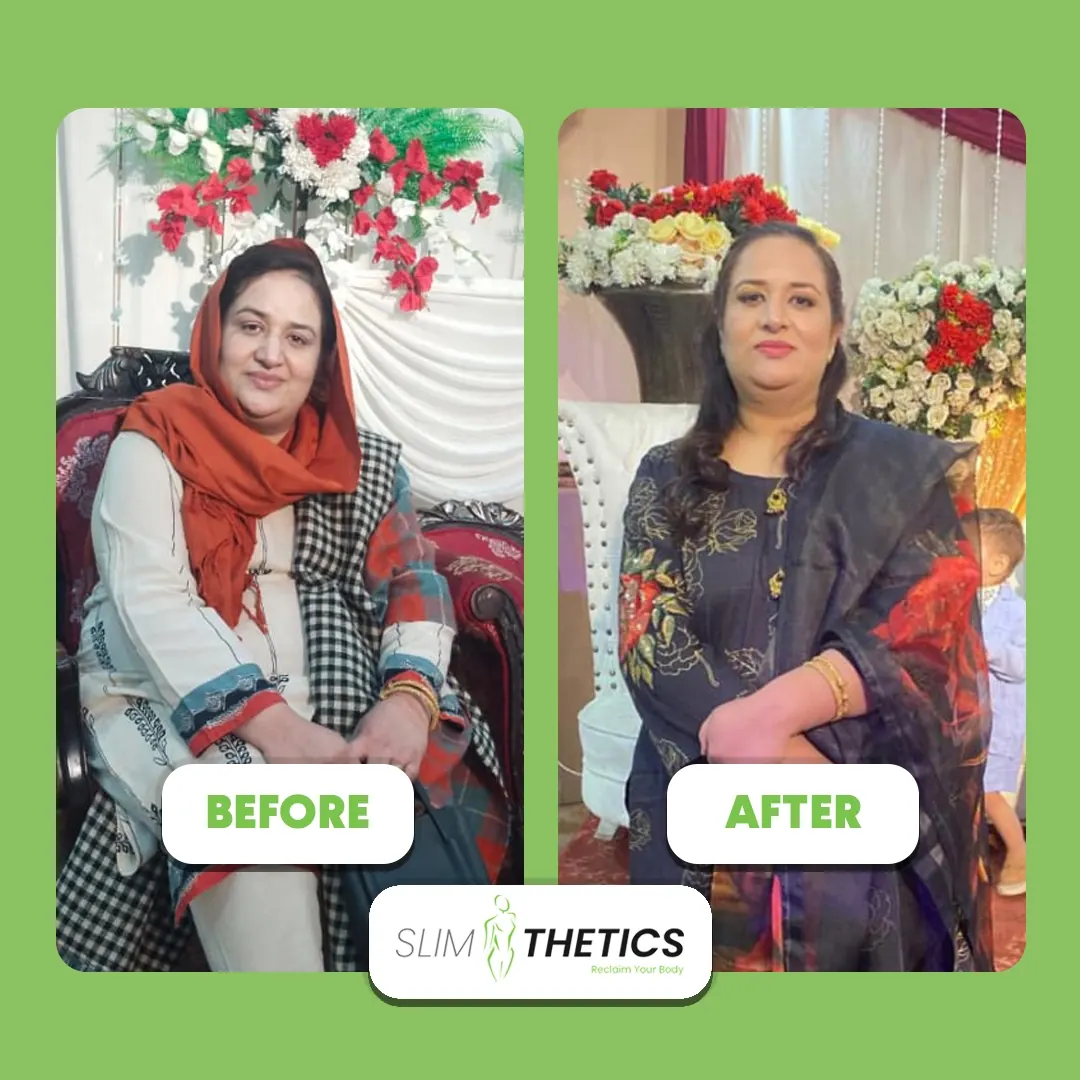 Saira A. — Mini Gastric Bypass patient at JJ Aesthetics Islamabad