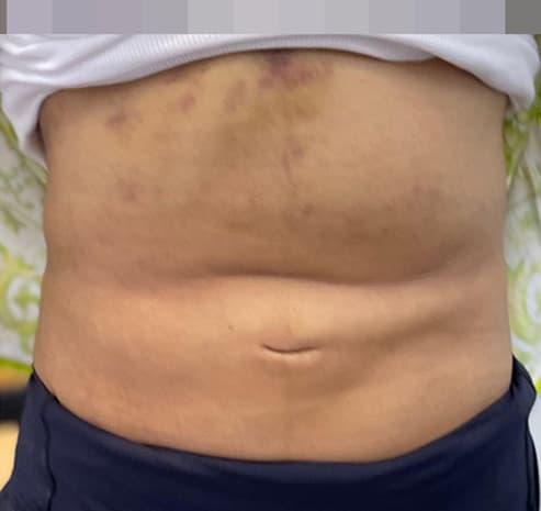 Abdomen after liposuction surgery