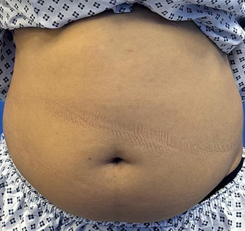 Abdomen liposuction before surgery
