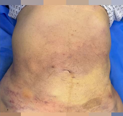 Abdomen after liposuction surgery