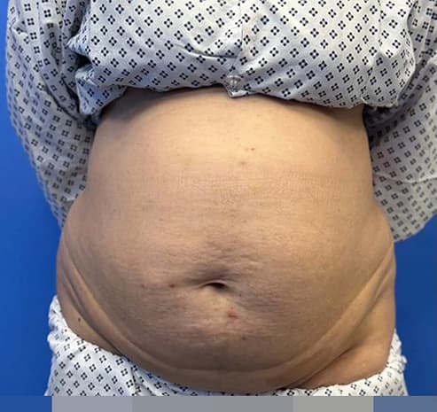 Abdomen liposuction before surgery