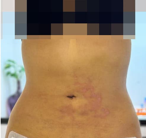 Abdomen after liposuction surgery