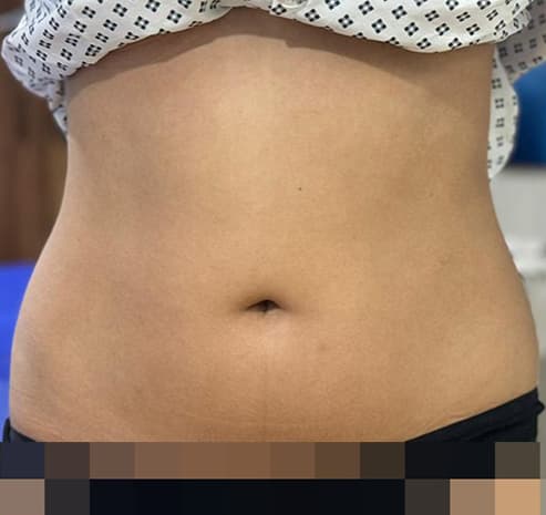 Abdomen liposuction before surgery