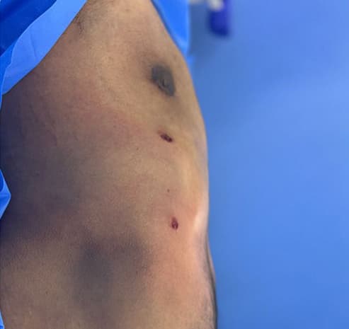 Male chest after liposuction surgery