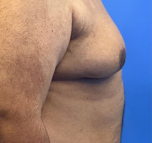 Male chest liposuction before surgery