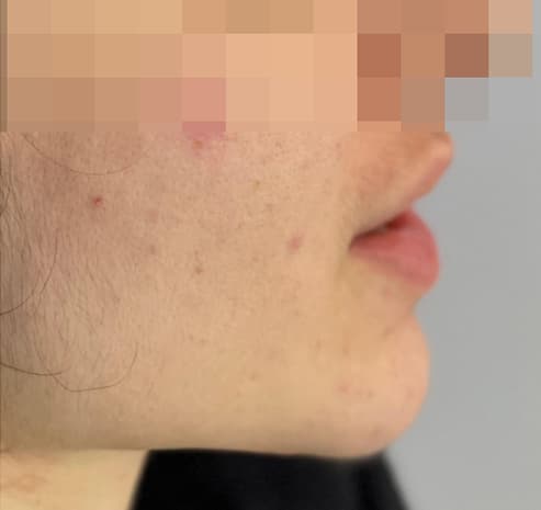 Chin & neck after liposuction surgery