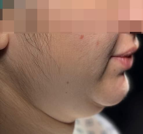 Chin & neck liposuction before surgery