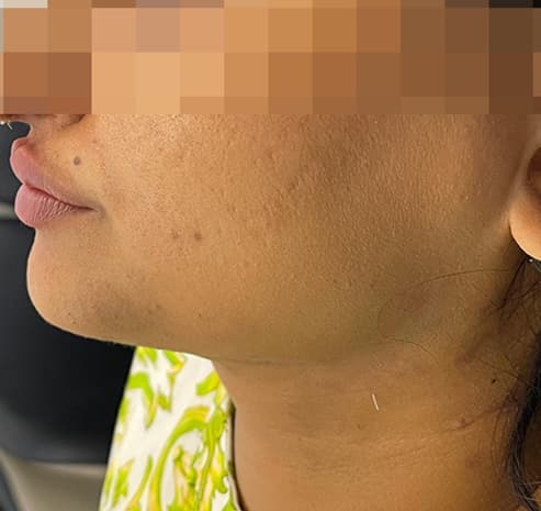 Chin & neck after liposuction surgery