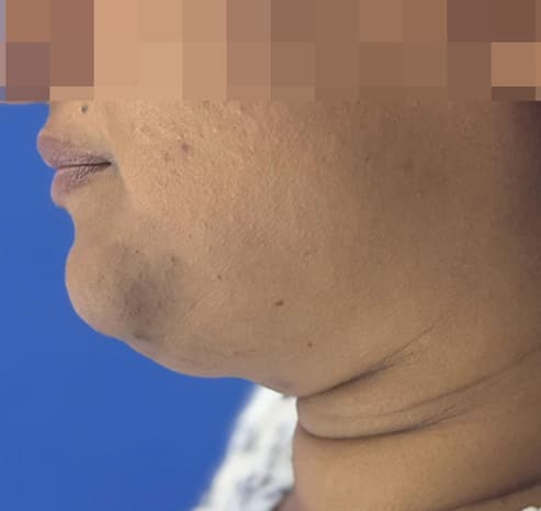 Chin & neck liposuction before surgery