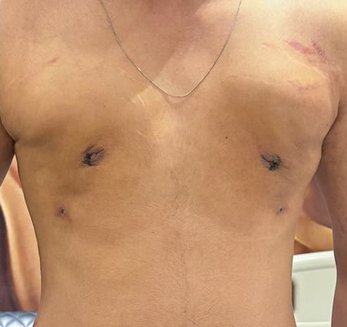 Grade I chest after gynecomastia surgery