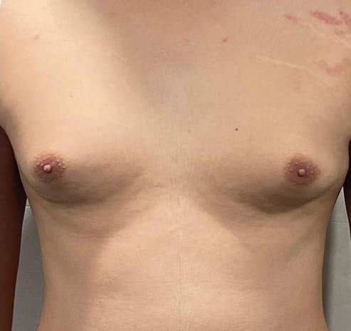 Grade I gynecomastia before surgery