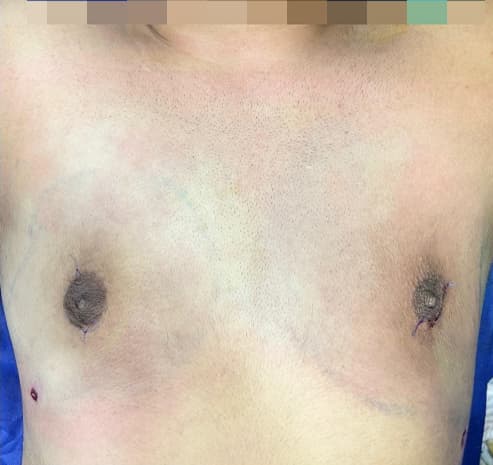 Grade II chest after gynecomastia surgery