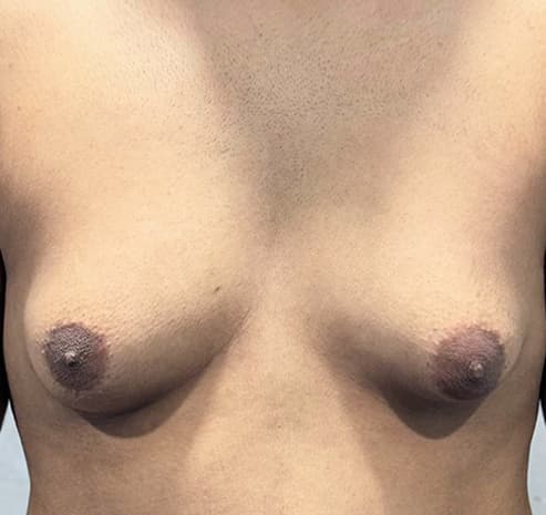 Grade II gynecomastia before surgery