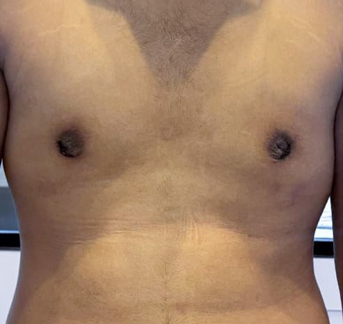 Grade II chest after gynecomastia surgery