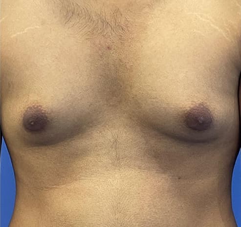Grade II gynecomastia before surgery