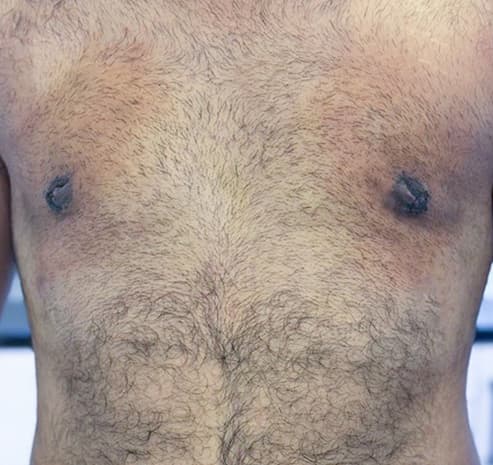 Grade I chest after gynecomastia surgery