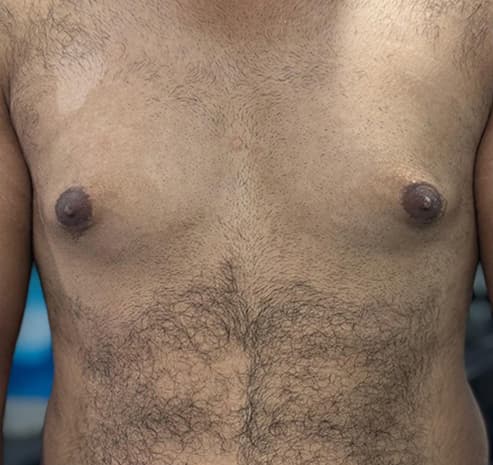 Grade I gynecomastia before surgery