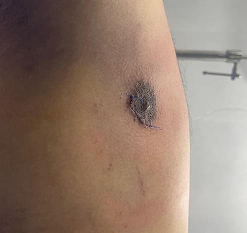 Grade II chest after gynecomastia surgery