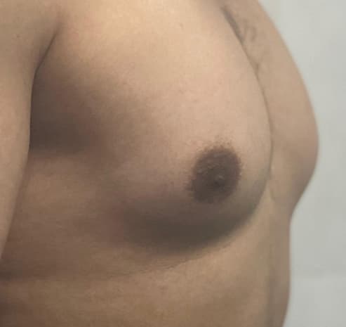 Grade II gynecomastia before surgery