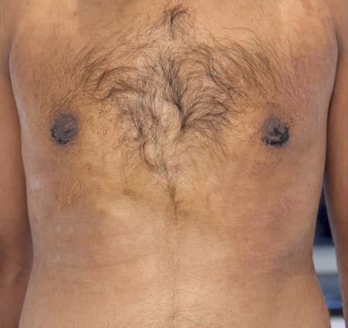 Grade II chest after gynecomastia surgery