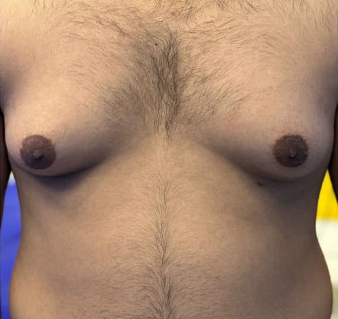 Grade II gynecomastia before surgery